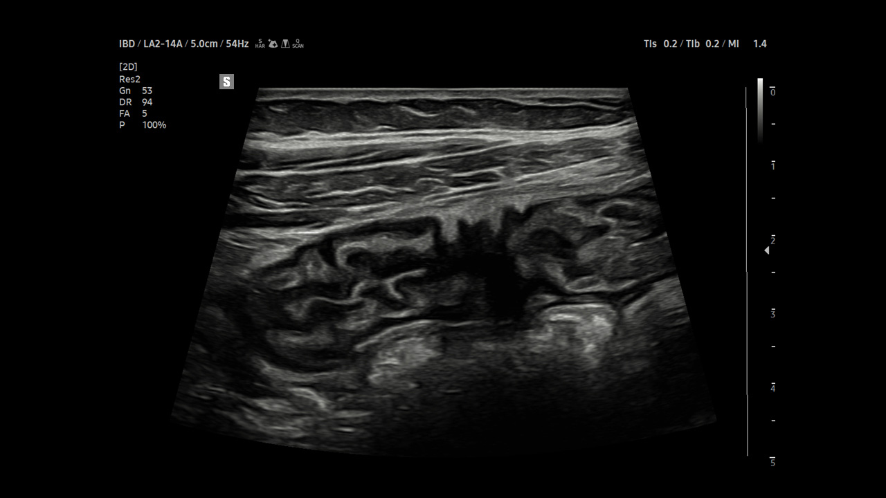 Abdomen Bowel visualization on Samsung V8
