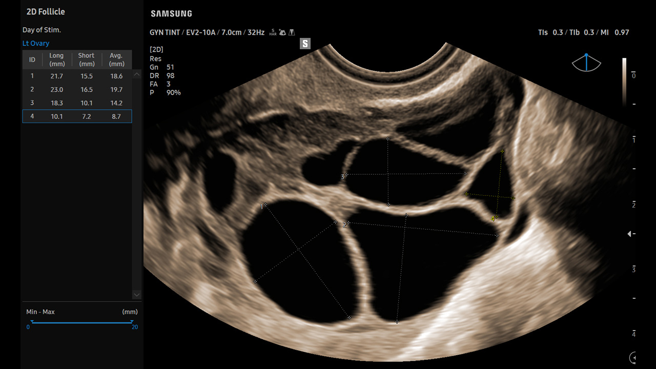 GYN 2D Follicle visualization on Samsung V8