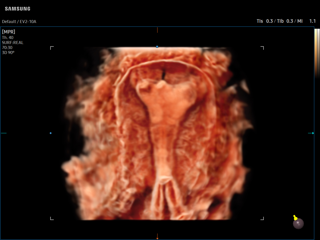 GYN HyCoSy visualization with CrystalVue™ on Samsung V8