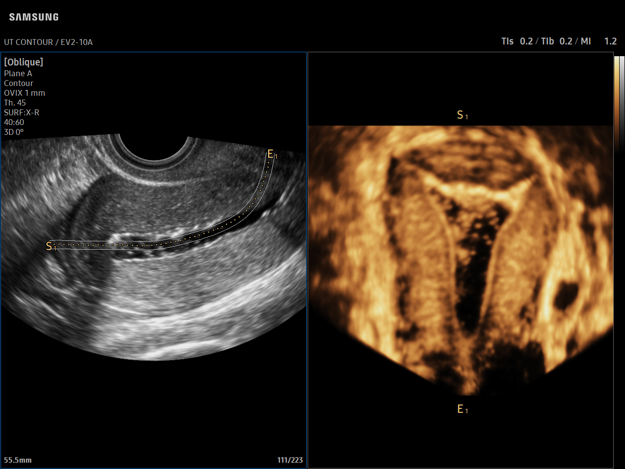 GYN Uterus visualization with UterineContour™ on Samsung V8