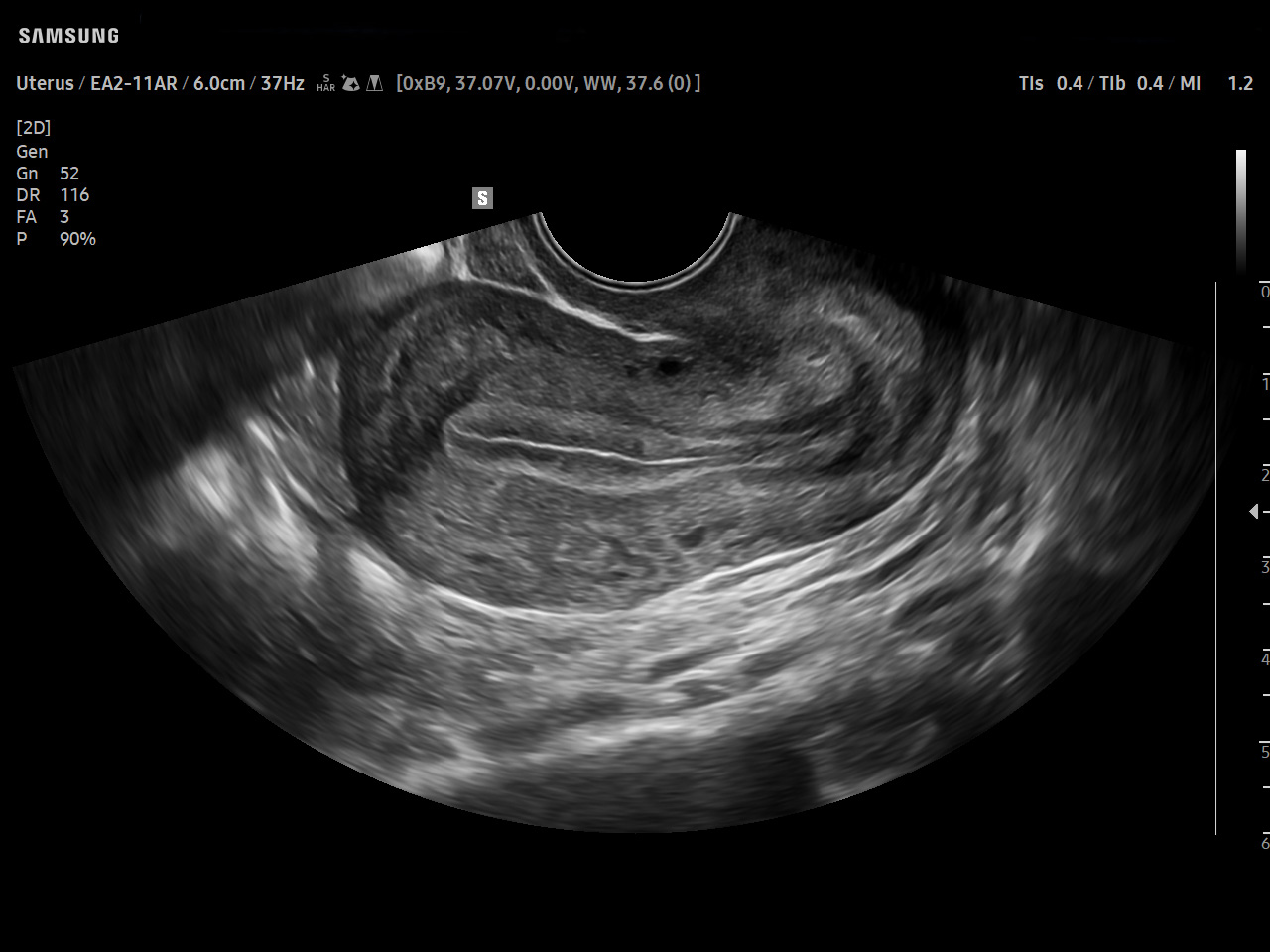 GYN Uterus visualization with ClearVision on Samsung V8