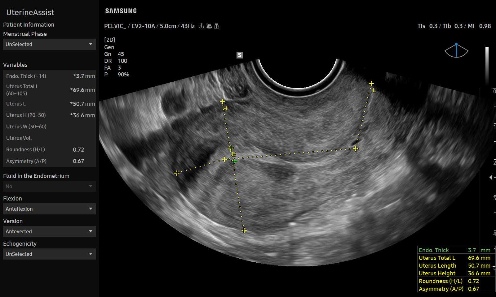 GYN Uterus visualization with UterineAssist™ on Samsung V8
