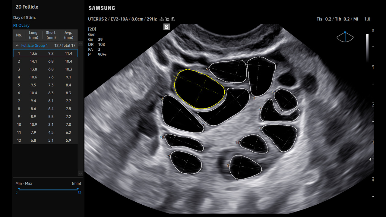 GYN 2D Follicle visualization on Samsung V7