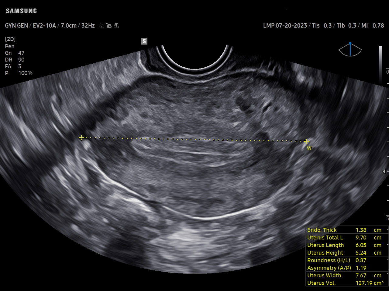 GYN Uterus visualization with UterineAssist™ on Samsung V7