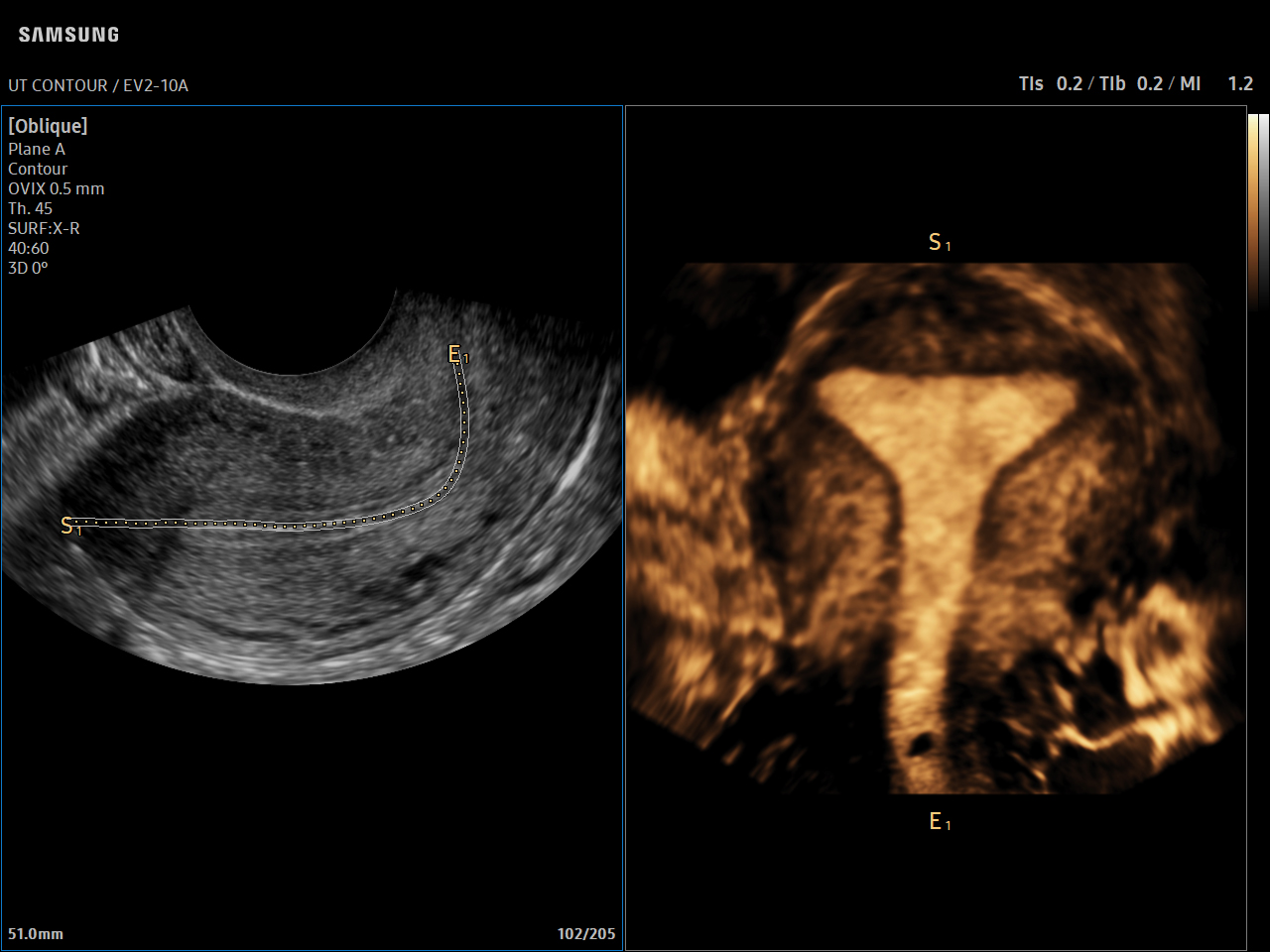 GYN Uterus visualization with UterineContour™ on Samsung V7