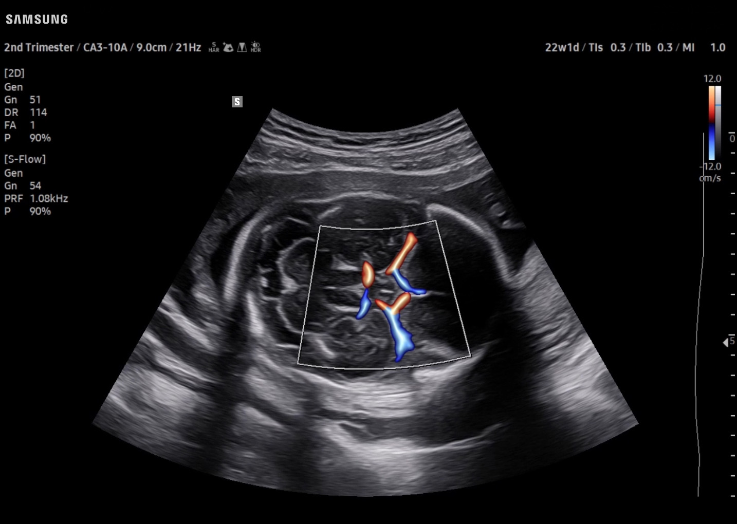 OB Fetal Brain visualization with S-Flow with LumiFlow on Samsung V7