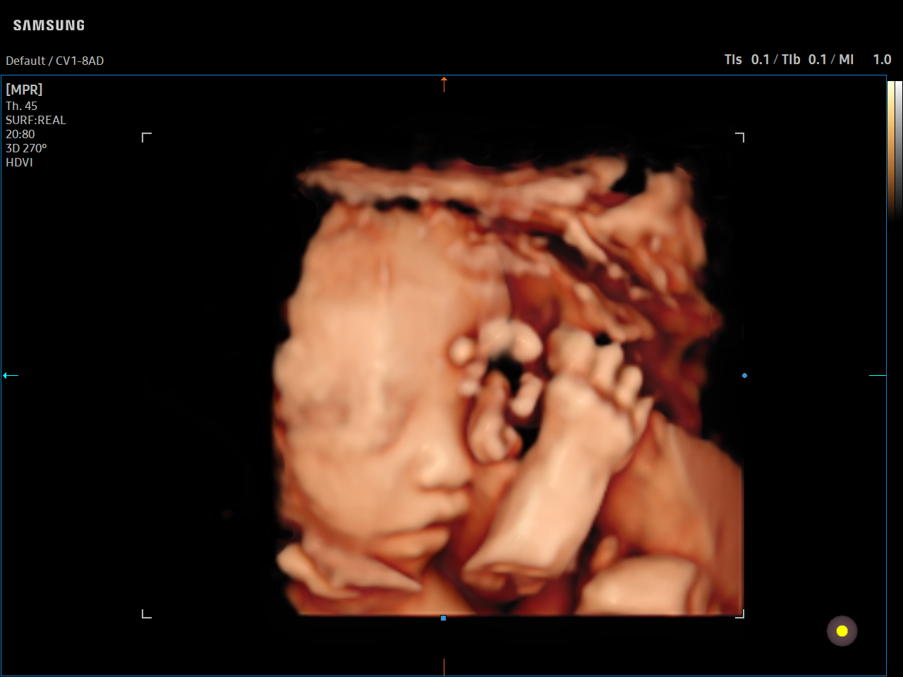 OB Fetal Face and Hand visualization with RealisticVue on Samsung V7