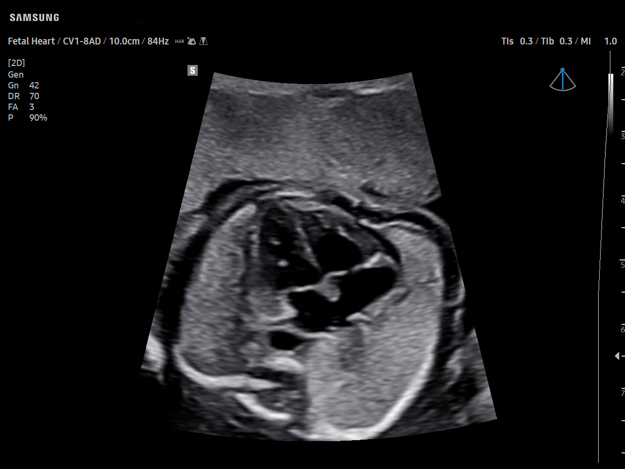 OB Fetal Heart visualization with ClearVision on Samsung V7