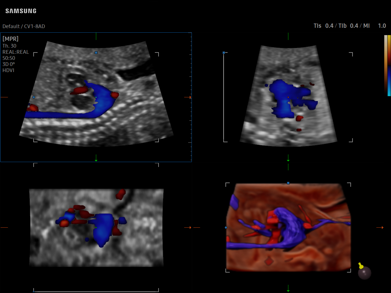 OB Fetal Heart visualization with CrystalVue™ Flow on Samsung V7