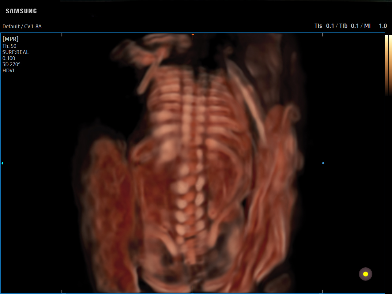 OB Fetal Spine visualization with CrystalVue™ on Samsung V7