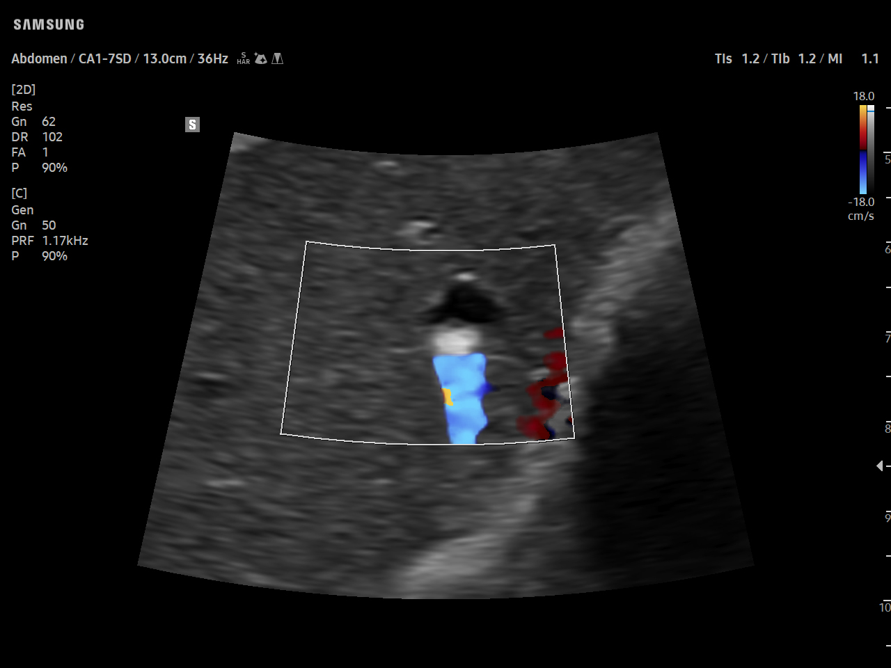 Abdomen Liver calcification with Color Ring down visualization on Samsung V5