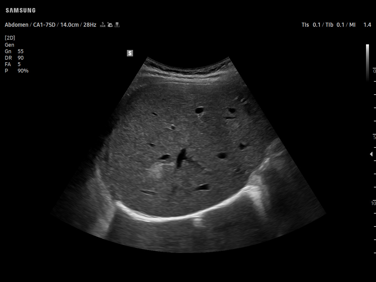 Abdomen Liver hemangioma visualization on Samsung V5