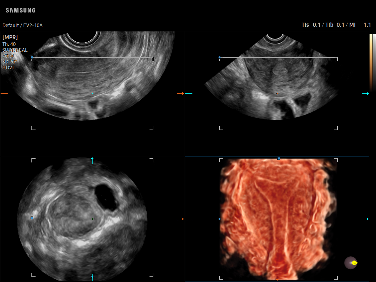 GYN Uterus visualization with CrystalVue™ on Samsung V5