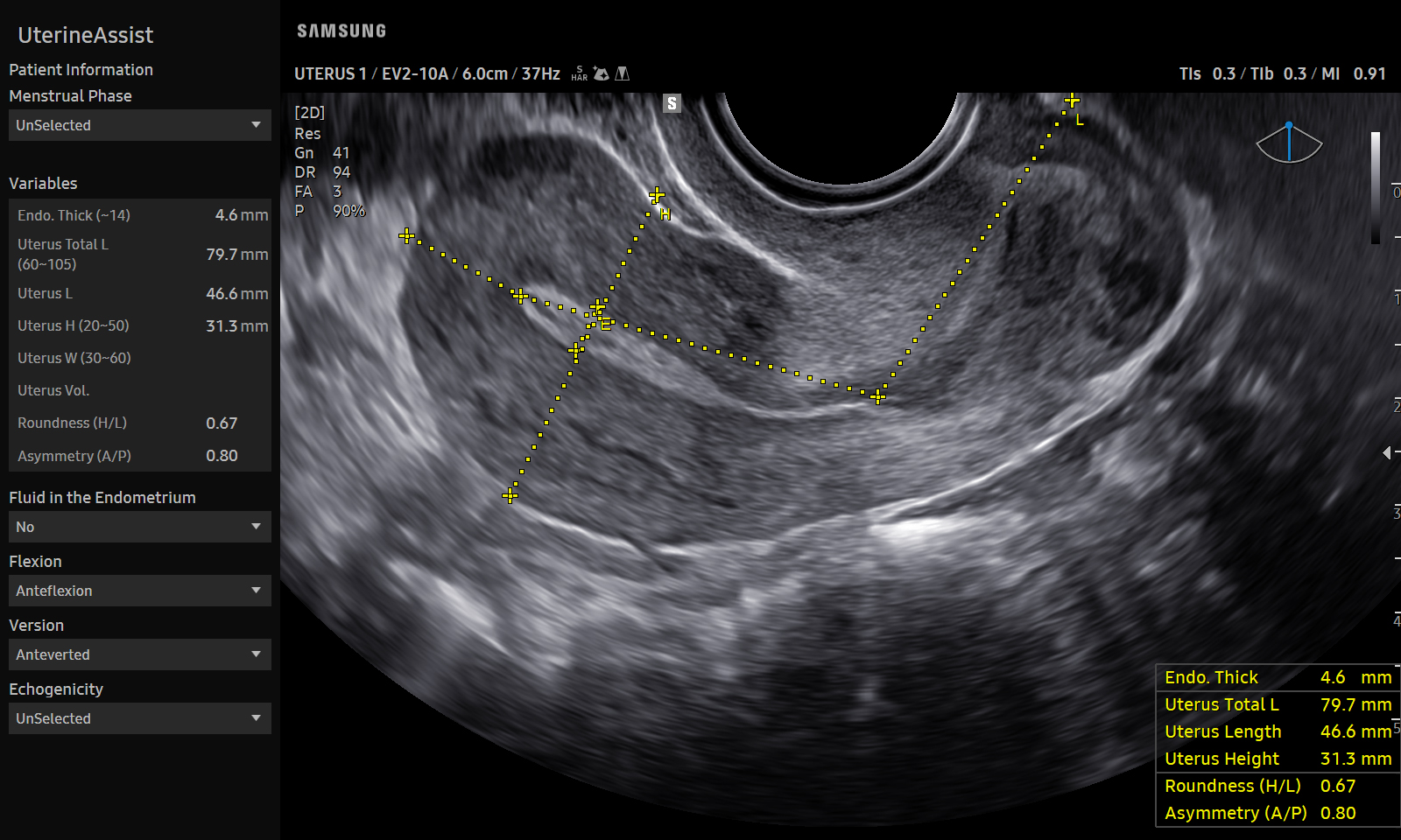 GYN Uterus visualization with UterineAssist™ on Samsung V5