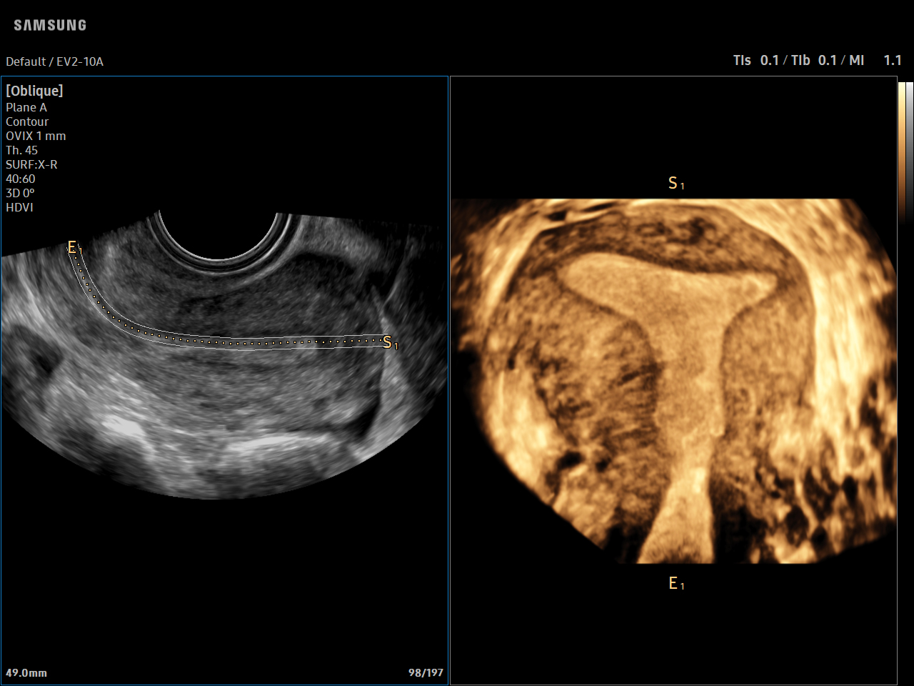 GYN Uterus visualization on Samsung V5