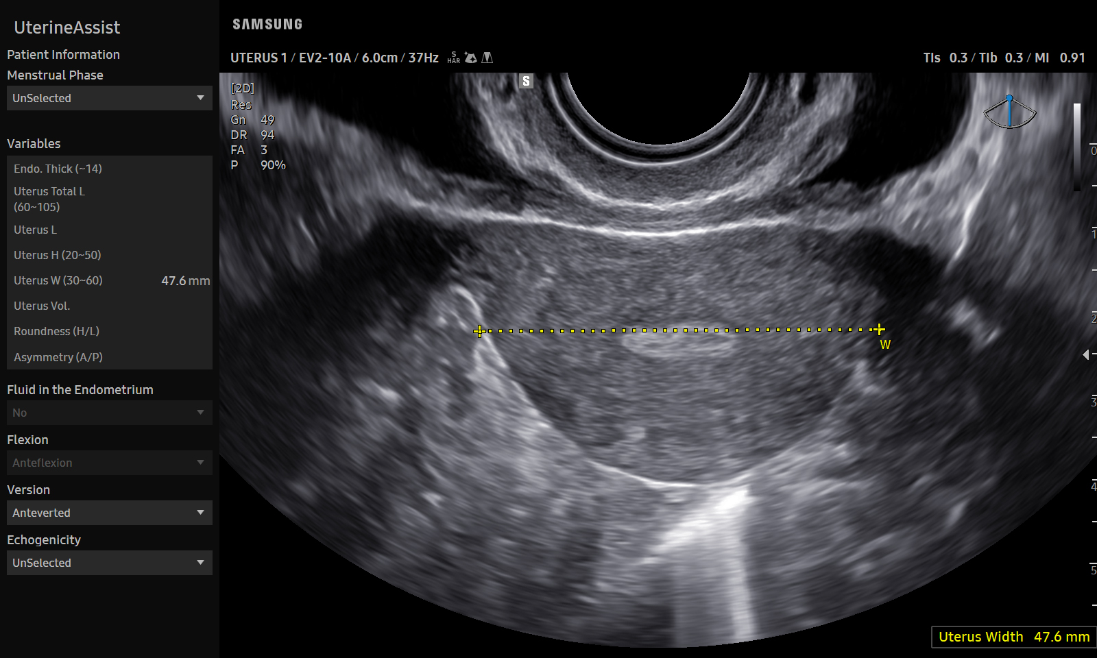 GYN Uterus visualization with UterineAssist™ on Samsung V5