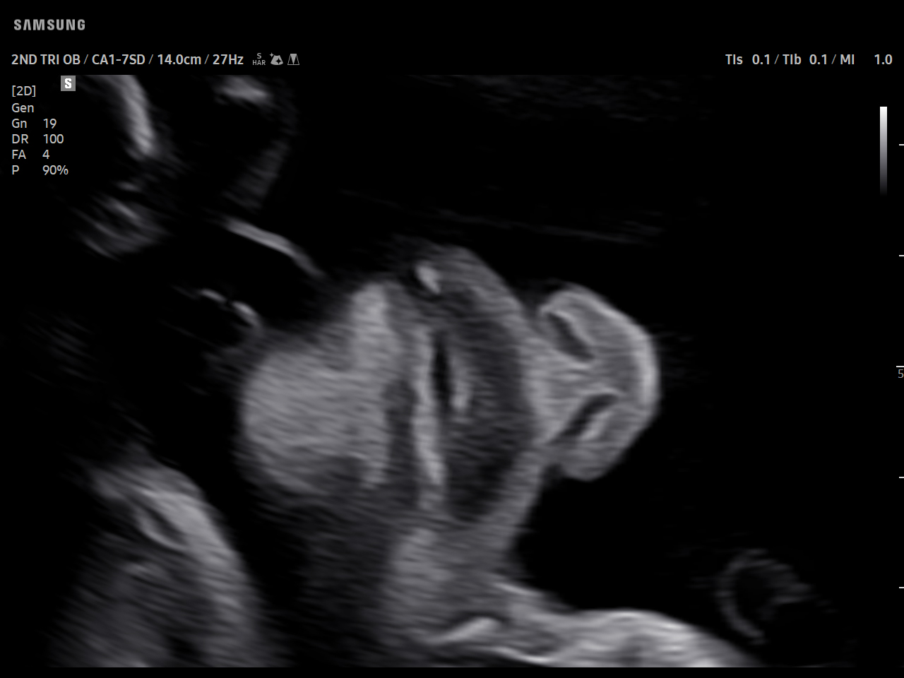 OB Fetal frontal face visualization on Samsung V5