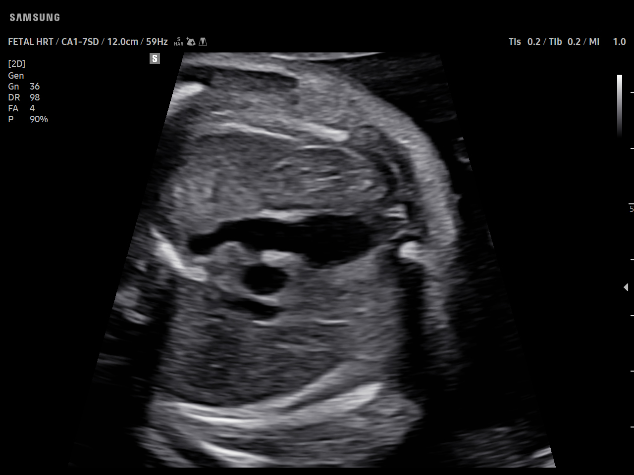 OB Fetal heart visualization on Samsung V5