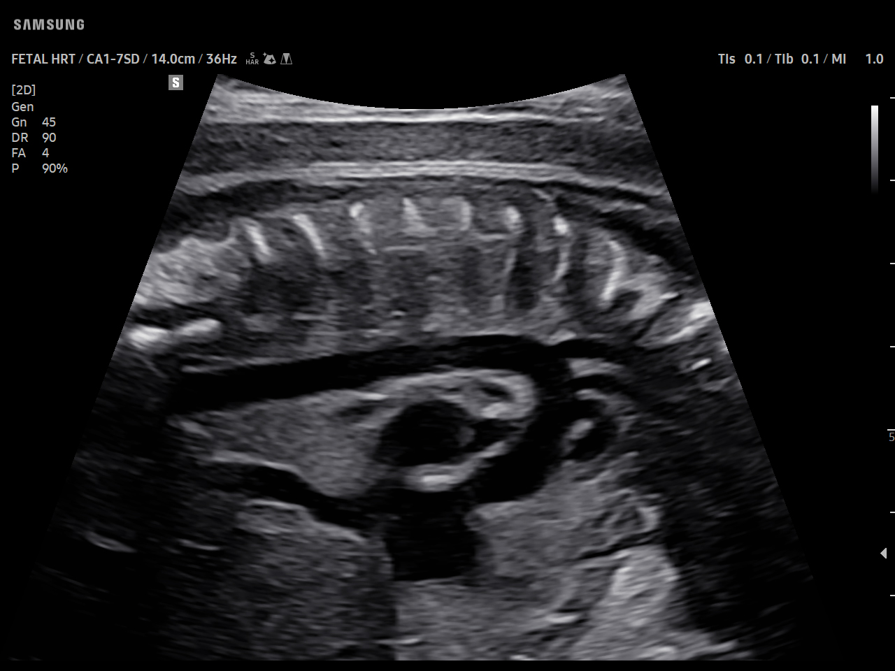 OB Fetal heart visualization on Samsung V5