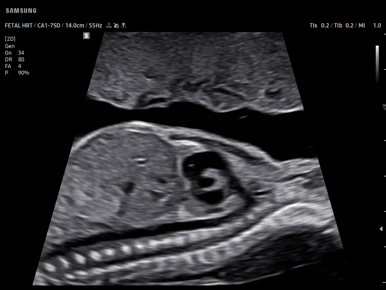 OB Fetal Heart visualization with Ductal arch view on Samsung V5