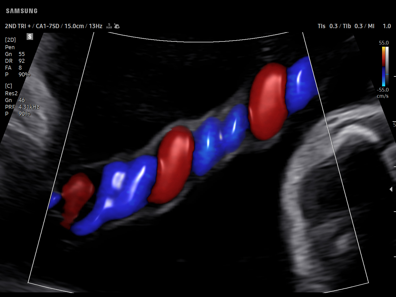 OB Umbilical cord visualization with LumiFlow on Samsung V5