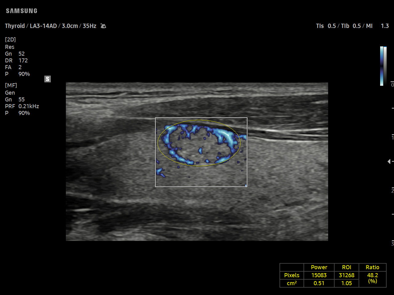 Small parts Thyroid visualization with MV-Flow™ on Samsung V5